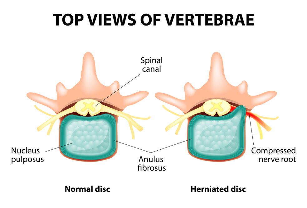 Zdravi intervertebralni disk i hernija