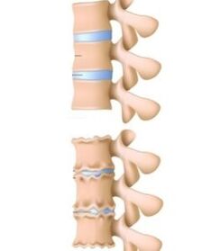 Uzroci osteohondroze