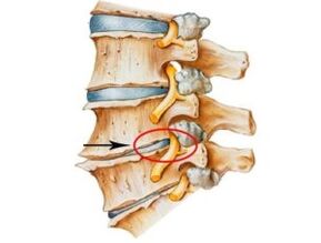 Znakovi i simptomi osteohondroze