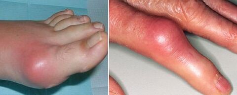 pojava zglobova s ​​artritisom