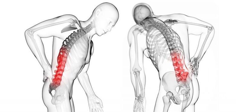 komplikacije s cervikalnom osteohondrozom